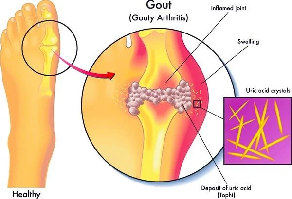 Tart Cherry Extract Good For Gout Tart Cherry Extract